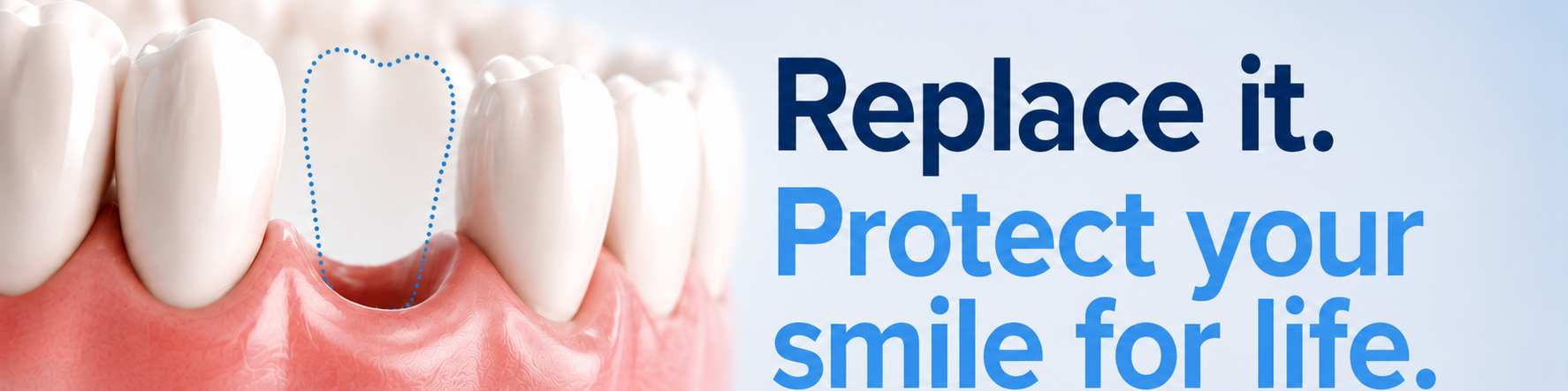 Why it's important to replace even a single missing tooth Why it's important to replace even a single missing tooth
